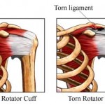 injury to rorator cuff shoulder