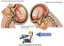Car Accident Head Trauma Vestibular Car Accident Head Trauma Vestibular