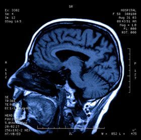 Cincinnati car accident brain injury